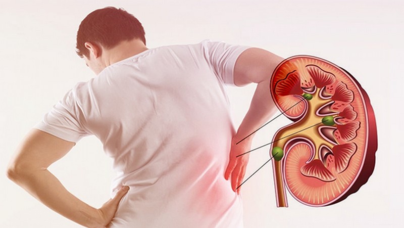 Vi khuẩn gây sỏi thận? Phát hiện mới làm thay đổi y học