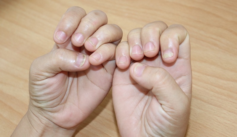 Các loại nấm móng tay