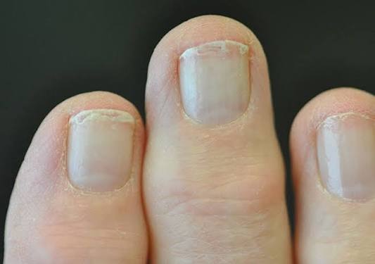 Cách phòng ngừa bệnh nấm móng tay