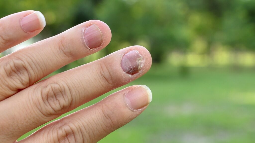 Điều trị móng tay bị nấm