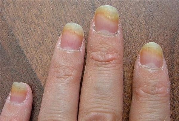 Nấm móng tay có nguy hiểm không
