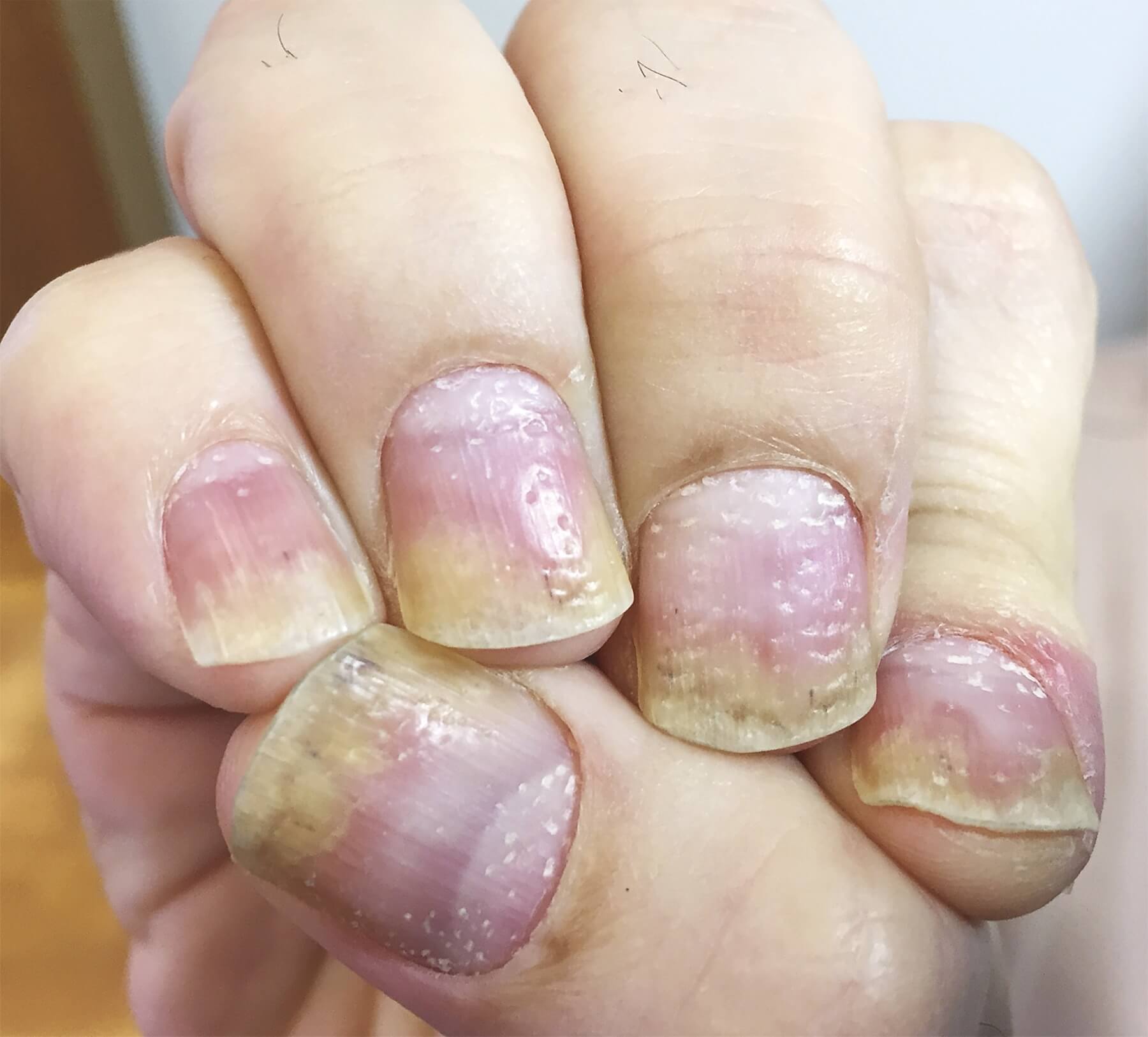 Nấm móng tay là bệnh gì