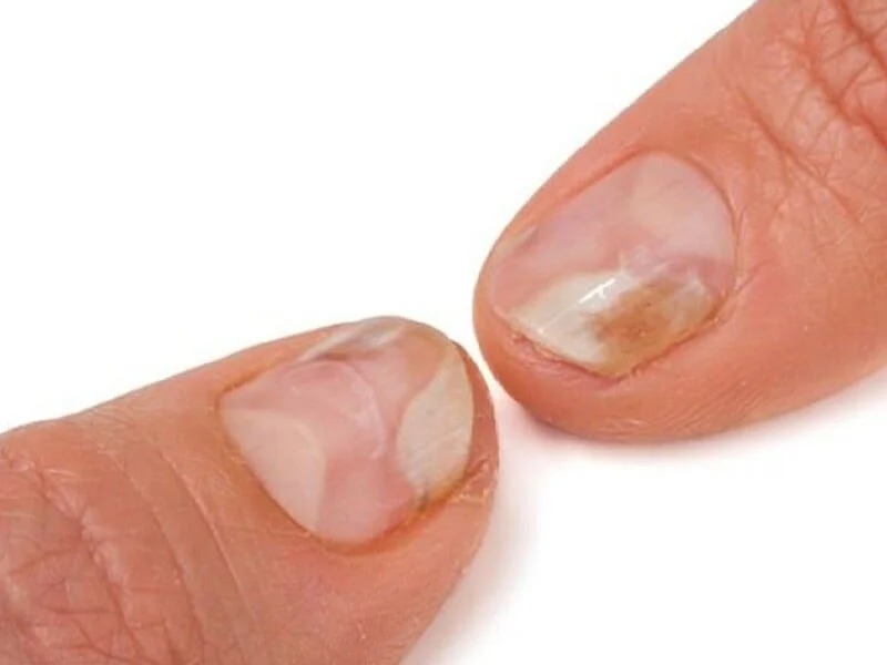 Nguyên nhân bị nấm móng tay