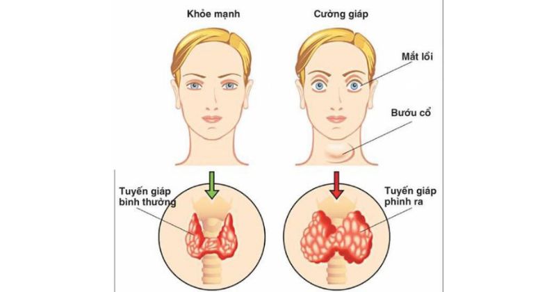 Bệnh cường giáp có nguy hiểm không_