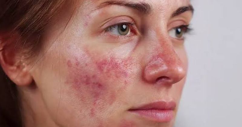 Bệnh lupus ban đỏ hệ thống ảnh hưởng đến tuổi thọ như thế nào