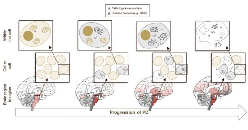 Các giai đoạn phát triển của bệnh parkinson