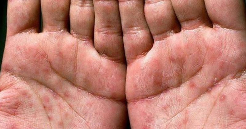 Dấu hiệu nhận biết bệnh giang mai