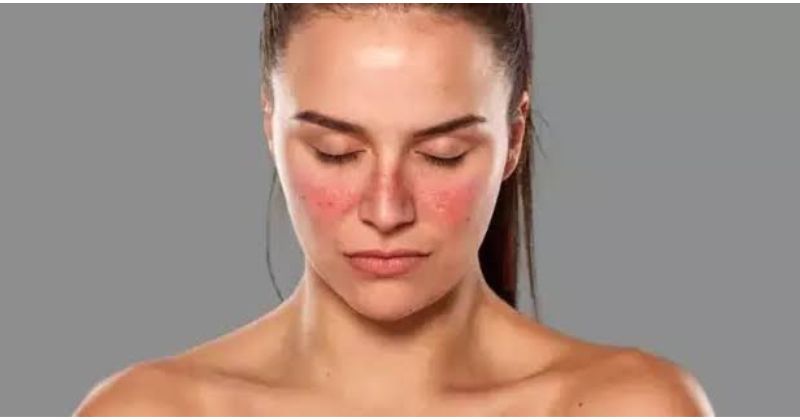 Phương pháp kiểm soát bệnh giúp người bệnh lupus kéo dài tuổi thọ